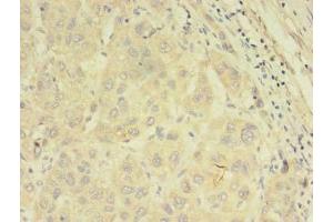 Immunohistochemistry of paraffin-embedded human liver cancer using ABIN7144889 at dilution of 1:100