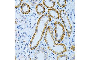 Immunohistochemistry of paraffin-embedded human kidney cancer using M Antibody (ABIN3016264, ABIN3016265, ABIN3016266, ABIN1680752 and ABIN6219676) at dilution of 1:200 (40x lens).