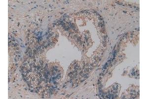 Detection of OPN in Human Prostate cancer Tissue using Polyclonal Antibody to Osteopontin (OPN)