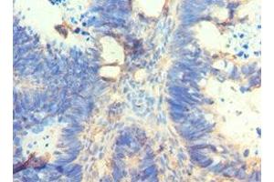 Immunohistochemistry of paraffin-embedded human ovarian cancer using ABIN7162566 at dilution of 1:100