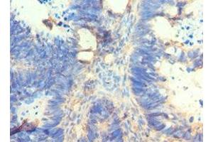 Immunohistochemistry of paraffin-embedded human ovarian cancer using ABIN7162566 at dilution of 1:100 (AMY2A anticorps  (AA 242-511))