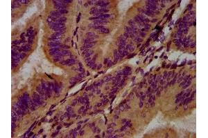 IHC image of ABIN7143399 diluted at 1:400 and staining in paraffin-embedded human endometrial cancer performed on a Leica BondTM system. (Adhesion G Protein-Coupled Receptor G1 (ADGRG1) (AA 26-216) anticorps)