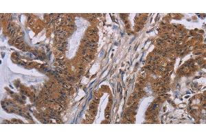 Immunohistochemistry of paraffin-embedded Human esophagus cancer tissue using GRK1 Polyclonal Antibody at dilution 1:40