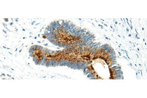 Immunohistochemistry of paraffin-embedded Human colorectal cancer using WWOX Polyclonal Antibody at dilution of 1/20 (WWOX anticorps)