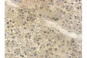 ABIN6261812 and ABIN6268892 at 1/100 staining human hepatocellular carcinoma by IHC-P. (FOSL2 anticorps  (C-Term))