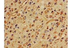 IHC image of ABIN7160401 diluted at 1:400 and staining in paraffin-embedded human glioma performed on a Leica BondTM system. (MBP anticorps  (AA 1-197))