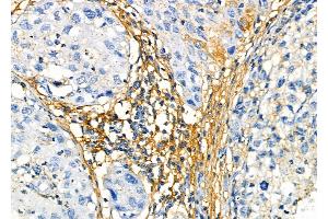 ABIN6265941 and ABIN6272458 at 1/100 staining Human pancreatic cancer by IHC-P. (Vomeronasal 1 Receptor 3 (VMN1R3) (Internal Region) anticorps)