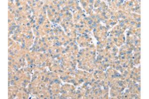 The image on the left is immunohistochemistry of paraffin-embedded Human liver cancer tissue using ABIN7128073(VAPA Antibody) at dilution 1/30, on the right is treated with fusion protein. (VAPA anticorps)