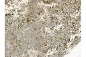ABIN6264671 and ABIN6273069 at 1/100 staining human melanoma by IHC-P.