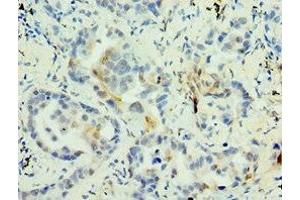 Immunohistochemistry of paraffin-embedded human lung cancer using ABIN7159272 at dilution of 1:100 (MAGEA6 anticorps  (AA 75-314))