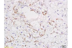 Formalin-fixed and paraffin embedded human colon carcinoma tissue labeled with Anti VEGF Polyclonal Antibody, unconjugated (ABIN674829) at 1:200 followed by incubation with conjugated secondary antibody and DAB staining. (VEGF anticorps)
