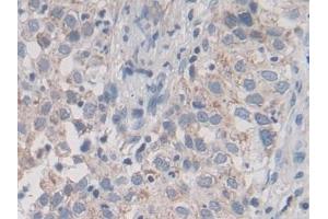 Detection of ABCA3 in Human Lung cancer Tissue using Polyclonal Antibody to ATP Binding Cassette Transporter A3 (ABCA3)