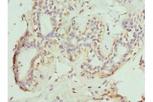 Immunohistochemistry of paraffin-embedded human breast cancer using ABIN7161014 at dilution of 1:100 (NOX5 anticorps  (AA 661-765))