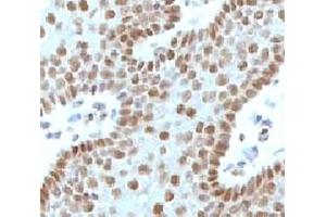 IHC testing of FFPE human cervical carcinoma and c-Myc antibody (MVH39-1).
