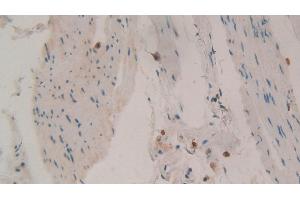 Detection of TIMP1 in Human Stomach cancer Tissue using Polyclonal Antibody to Tissue Inhibitors Of Metalloproteinase 1 (TIMP1)