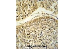 RERE Antibody (N-term) (ABIN653912 and ABIN2843149) IHC analysis in formalin fixed and paraffin embedded lung carcinoma followed by peroxidase conjugation of the secondary antibody and DAB staining.