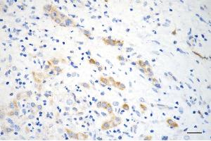 Immunohistochemistry was performed on paraffin-embedded human hepatocarcinoma using ACSL4 antibody (ABIN7797498), 1:200). (Recombinant ACSL4 anticorps)