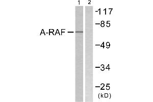 Immunohistochemistry analysis of paraffin-embedded human breast carcinoma tissue using A-RAF (Ab-301/302) antibody. (ARAF anticorps  (Tyr301, Tyr302))