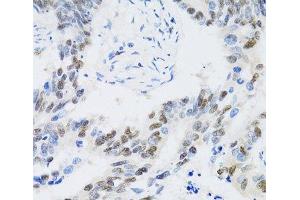 Immunohistochemistry of paraffin-embedded Human colon carcinoma using CDK6 Polyclonal Antibody at dilution of 1:100 (40x lens). (CDK6 anticorps)