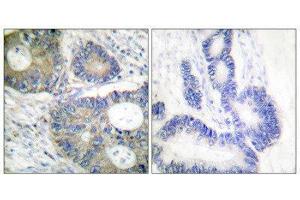 Immunohistochemistry (IHC) image for anti-Eukaryotic Translation Initiation Factor 4E Binding Protein 1 (EIF4EBP1) (Ser65) antibody (ABIN1847928)