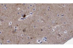ABIN6278497 at 1/100 staining Human brain cancer tissue by IHC-P. (Reticulon 4 anticorps  (Internal Region))