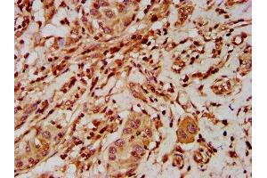 IHC image of ABIN7151576 diluted at 1:500 and staining in paraffin-embedded human liver cancer performed on a Leica BondTM system. (ELP2 anticorps  (AA 323-457))
