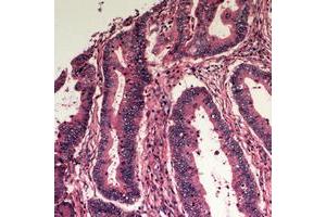 Immunohistochemical analysis of Apolipoprotein L3 staining in human colon cancer formalin fixed paraffin embedded tissue section.