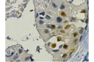 Immunohistochemistry (IHC) staining of Human Breast cancer tissue paraffin-embedded, diluted at 1:200.
