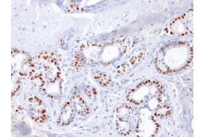 Formalin-fixed, paraffin-embedded human Breast Carcinoma stained with Estrogen Receptor alpha Mouse Monoclonal Antibody (ESR1/1904).