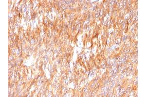 Formalin-fixed, paraffin-embedded human Small Intestinal Carcinoma stained with Calnexin Mouse Monoclonal Antibody (CANX/1541).