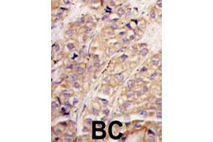 Formalin-fixed and paraffin-embedded human breast carcinoma tissue reacted with SMURF1 polyclonal antibody  , which was peroxidase-conjugated to the secondary antibody, followed by DAB staining. (SMURF1 anticorps  (N-Term))