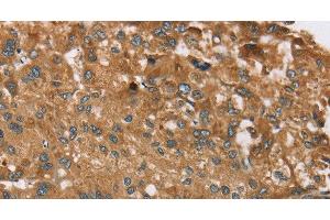 Immunohistochemistry of paraffin-embedded Human liver cancer tissue using RPS6KA2 Polyclonal Antibody at dilution 1:40 (RPS6KA2 anticorps)