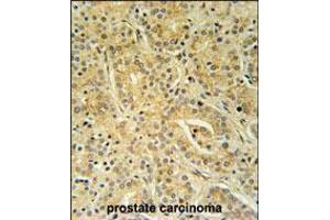 UBAC1 Antibody immunohistochemistry analysis in formalin fixed and paraffin embedded human prostate carcinoma followed by peroxidase conjugation of the secondary antibody and DAB staining. (UBAC1 anticorps  (C-Term))