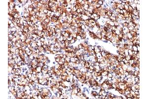 Formalin-fixed, paraffin-embedded human Renal Cell Carcinoma stained with CAIX Mouse Monoclonal Antibody (CA9/781). (CA9 anticorps)