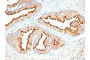 Formalin-fixed, paraffin-embedded human Prostate Carcinoma stained with CD10 Mouse Monoclonal Antibody (MME/2579).