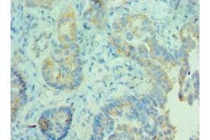 Immunohistochemistry of paraffin-embedded human lung cancer using ABIN7158946 at dilution of 1:100 (MDH2 anticorps  (AA 59-338))