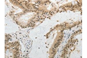 The image on the left is immunohistochemistry of paraffin-embedded Human colon cancer tissue using ABIN7130225(MGEA5 Antibody) at dilution 1/20, on the right is treated with fusion protein. (MGEA5 anticorps)