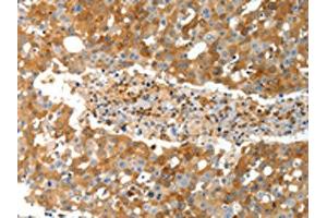 The image on the left is immunohistochemistry of paraffin-embedded Human breast cancer tissue using (TEP1 Antibody) at dilution 1/40, on the right is treated with synthetic peptide. (TEP1 anticorps)
