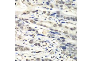 Immunohistochemistry of paraffin-embedded human gastric cancer using NUDT1 antibody.