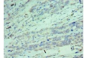 Immunohistochemistry of paraffin-embedded human endometrial cancer using ABIN7148906 at dilution of 1:100