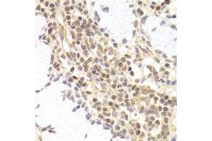 Immunohistochemistry of paraffin-embedded human adenomyosis using PHC1 antibody (ABIN5973455) at dilution of 1/200 (40x lens). (PHC1 anticorps)