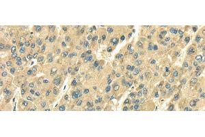 Immunohistochemistry of paraffin-embedded Human liver cancer tissue using SDF4 Polyclonal Antibody at dilution 1:35