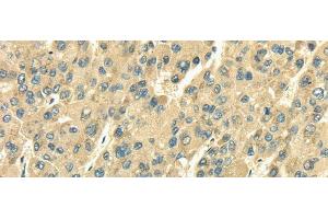 Immunohistochemistry of paraffin-embedded Human liver cancer tissue using SDF4 Polyclonal Antibody at dilution 1:35 (SDF4 anticorps)