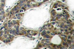 Immunohistochemistry (IHC) analyzes of Catenin-beta antibody in paraffin-embedded human breast carcinoma tissue. (CTNNB1 anticorps)