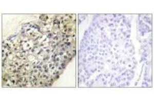 Immunohistochemistry analysis of paraffin-embedded human breast carcinoma tissue, using LATH antibody. (BPIFA4P anticorps)