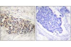 Immunohistochemistry analysis of paraffin-embedded human breast carcinoma tissue, using USF2 Antibody.
