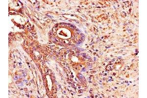 Immunohistochemistry of paraffin-embedded human prostate cancer using ABIN7150038 at dilution of 1:100