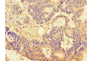 Immunohistochemistry of paraffin-embedded human colon cancer using ABIN7160076 at dilution of 1:100