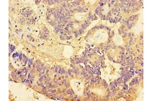 Immunohistochemistry of paraffin-embedded human colon cancer using ABIN7160076 at dilution of 1:100 (BUB3 anticorps  (AA 6-217))