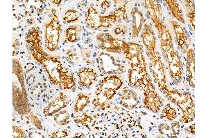 Phospho-ILK (Ser246) Antibody at 1/100 staining Human kidney cancer and adjacent normal tissues by IHC-P.